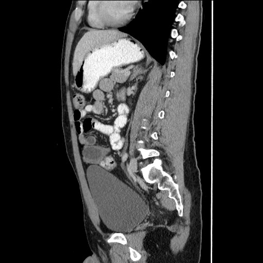 File:Closed-loop small bowel obstruction (Radiopaedia 73713-84509 B 101).jpg