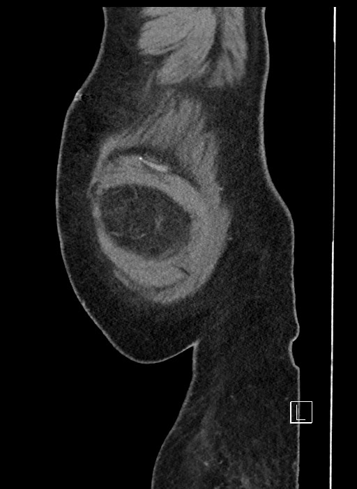 Closed loop obstruction - internal hernia into nephrectomy bed (Radiopaedia 59867-67320 C 108).jpg