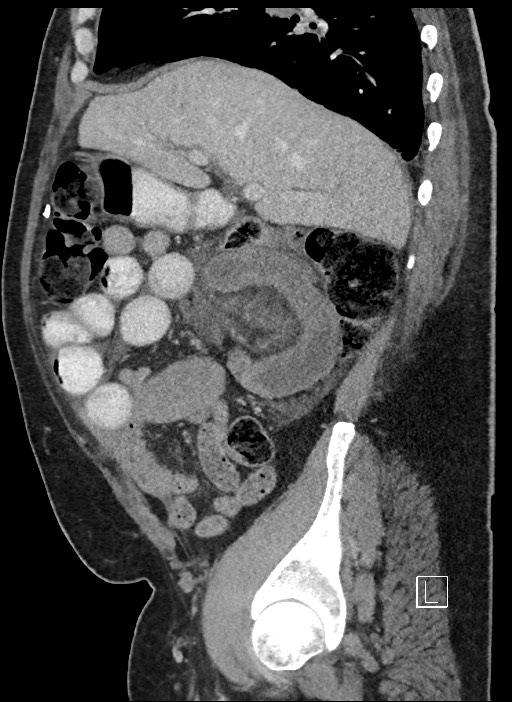 Closed loop obstruction - internal hernia into nephrectomy bed (Radiopaedia 59867-67320 C 72).jpg