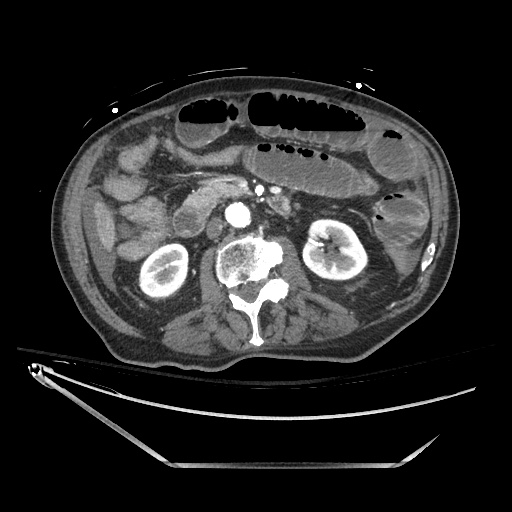 Closed loop obstruction due to adhesive band, resulting in small bowel ischemia and resection (Radiopaedia 83835-99023 B 67).jpg