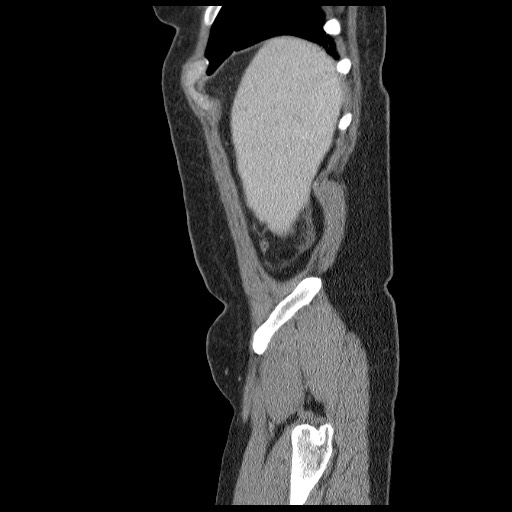 File:Closed loop small bowel obstruction (Radiopaedia 65403-74451 C 5).jpg