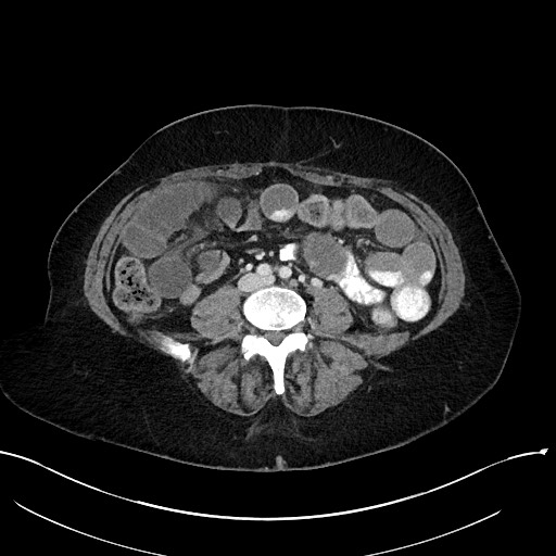 File:Closed loop small bowel obstruction - adhesions (Radiopaedia 59078-66369 Axial 1).jpg