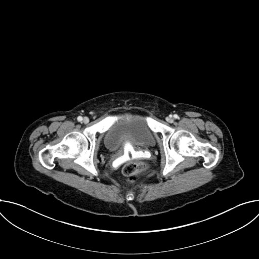Closed loop small bowel obstruction - adhesive band with a C-shaped loop (Radiopaedia 83832-99018 A 125).jpg