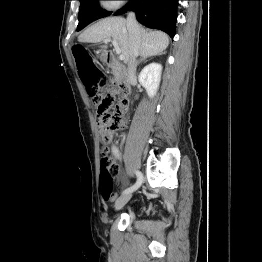 Closed loop small bowel obstruction - omental adhesion causing "internal hernia" (Radiopaedia 85129-100682 C 73).jpg