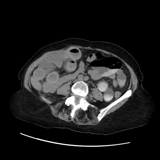 File:Closed loop small bowel obstruction due to adhesive band, with intramural hemorrhage and ischemia (Radiopaedia 83831-99017 Axial non-contrast 94).jpg