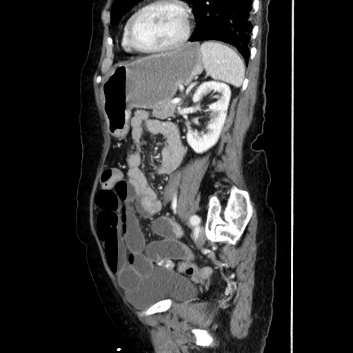 Closed loop small bowel obstruction due to adhesive band, with intramural hemorrhage and ischemia (Radiopaedia 83831-99017 D 128).jpg