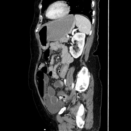 File:Closed loop small bowel obstruction due to adhesive band, with intramural hemorrhage and ischemia (Radiopaedia 83831-99017 D 133).jpg