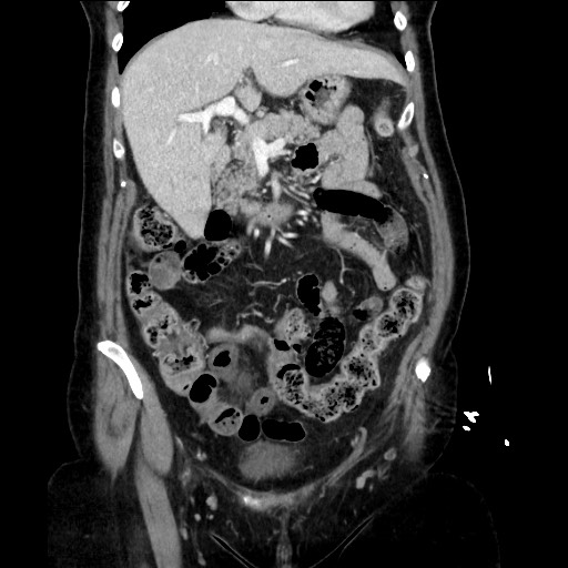 Closed loop small bowel obstruction due to adhesive bands - early and late images (Radiopaedia 83830-99014 B 47).jpg