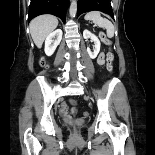 File:Closed loop small bowel obstruction due to adhesive bands - early and late images (Radiopaedia 83830-99014 B 83).jpg