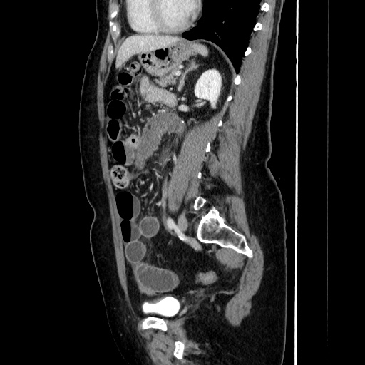 Closed loop small bowel obstruction due to adhesive bands - early and late images (Radiopaedia 83830-99015 C 111).jpg