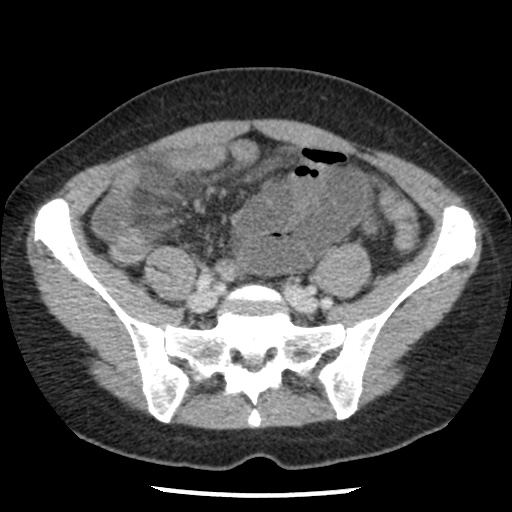 File:Closed loop small bowel obstruction due to trans-omental herniation (Radiopaedia 35593-37109 A 62).jpg