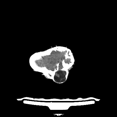 Cloverleaf skull (Radiopaedia 91901-109710 Axial non-contrast 134).jpg