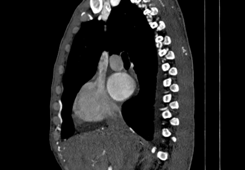 Coarctation of aorta with aortic valve stenosis (Radiopaedia 70463-80574 B 15).jpg