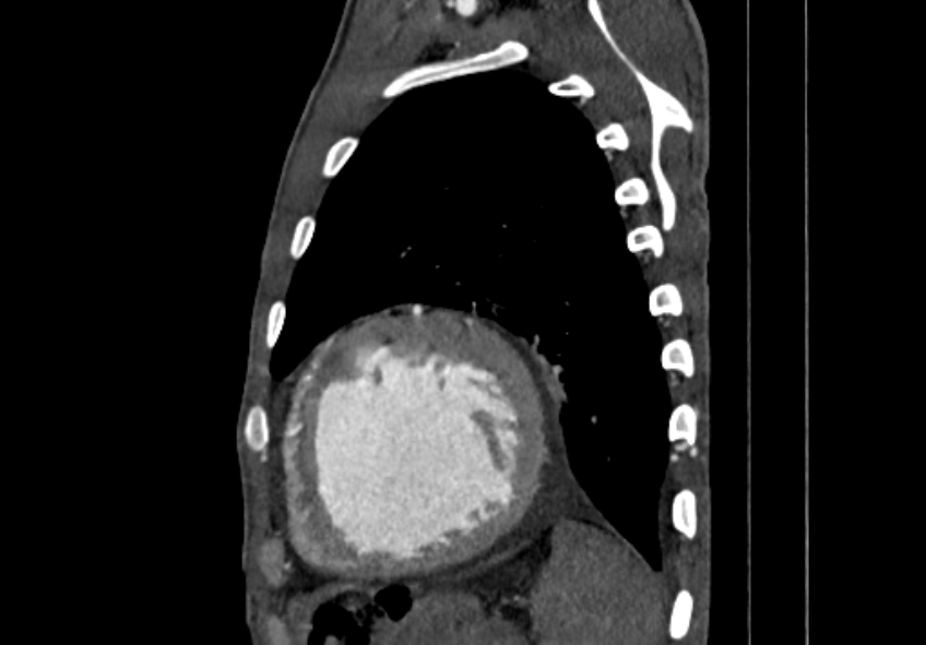 Coarctation of aorta with aortic valve stenosis (Radiopaedia 70463-80574 B 185).jpg