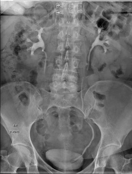 File:Cobra head sign - intravenous urogram (Radiopaedia 46539-50992 C 1).jpg