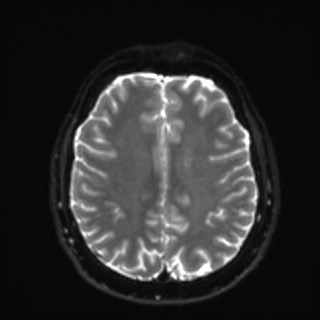 Cochlear incomplete partition type III associated with hypothalamic hamartoma (Radiopaedia 88756-105498 Axial DWI 28).jpg
