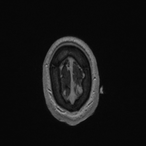 File:Colloid cyst (Radiopaedia 44510-48181 Axial T1 C+ 167).png
