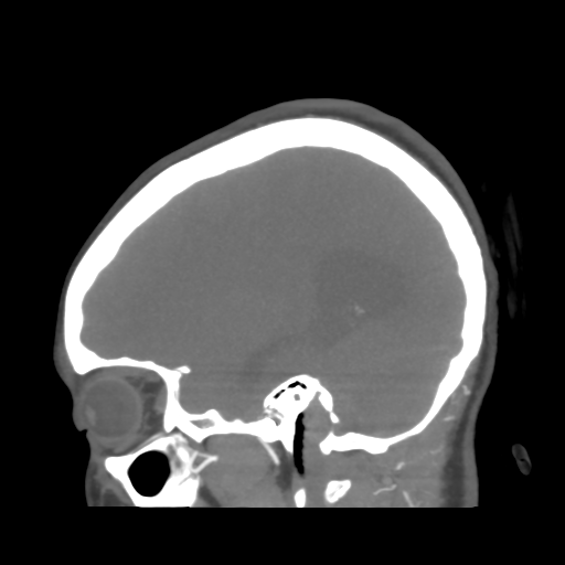 File:Colloid cyst (resulting in death) (Radiopaedia 33423-34499 B 41).png