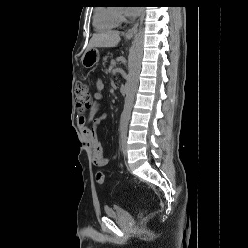 File:Colocutaneous fistula in Crohn's disease (Radiopaedia 29586-30093 C 27).jpg