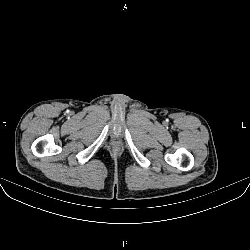 Colon adenocarcinoma - hepatic flexure (Radiopaedia 85635-101395 A 107).jpg