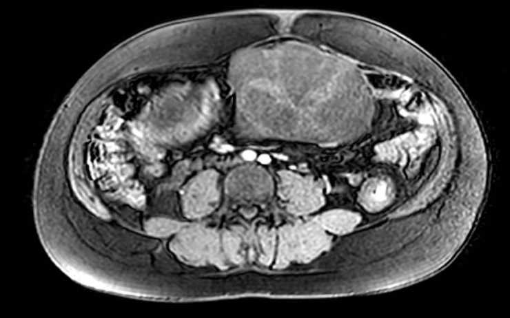 Colon adenocarcinoma with Krukenberg tumors, advanced pregnancy (Radiopaedia 67279-76645 A 39).jpg