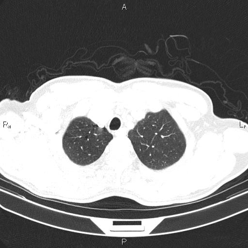File:Colon cancer (Radiopaedia 85663-101443 Axial lung window 9).jpg