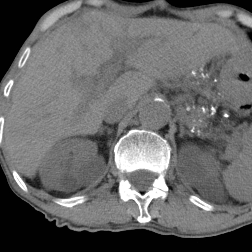 Colon cancer with calcified liver metastasis (Radiopaedia 74423-85309 Axial non-contrast 25).jpg