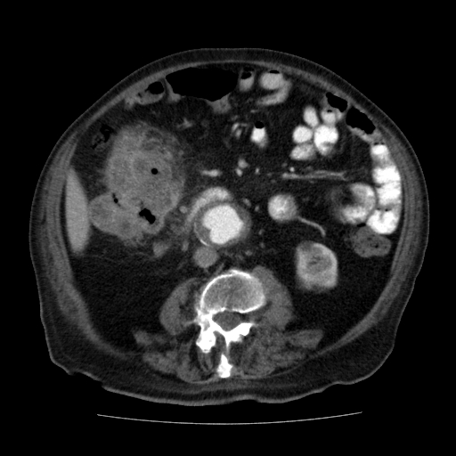 File:Colon cancer with duodenal invasion (Radiopaedia 16278-15958 A 32).jpg