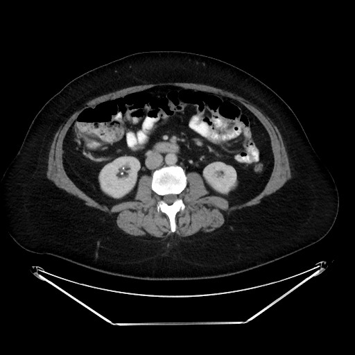File:Colonic intussusception due to adenocarcinoma (Radiopaedia 86828-102987 A 75).jpg
