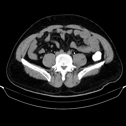 Colonic lipoma with colo-colic intussusception (Radiopaedia 58944-66200 Axial C+ rectal 44).jpg