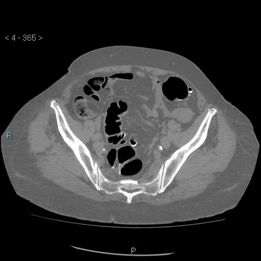 Colonic lipomas (Radiopaedia 49137-54244 Axial bone window 163).jpg