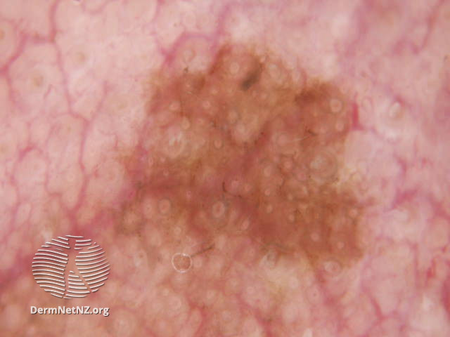File:Dermoscopic view of lentigo maligna showing pigmented circles and the isobar sign (DermNet NZ doctors-dermoscopy-course-images-circles54).jpg