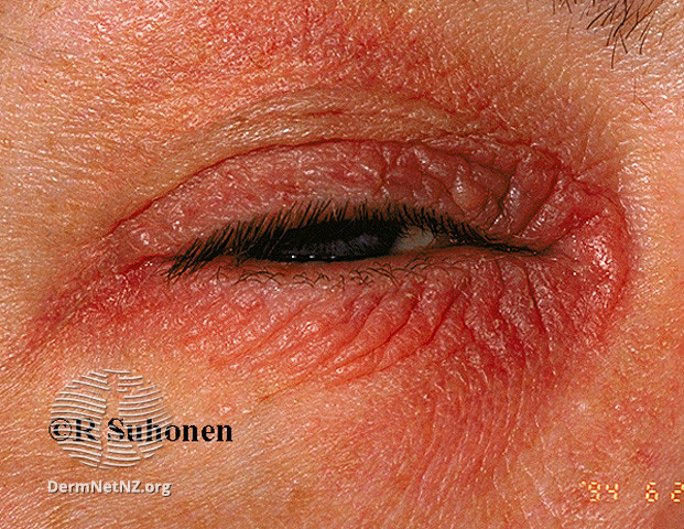 File:Eyelid contact dermatitis (DermNet NZ dermatitis-s-eyelid-dermatitis-10).jpg