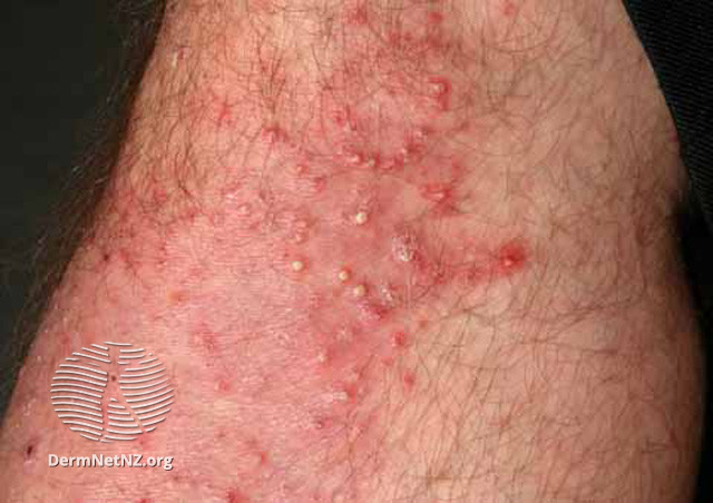 File:Folliculitis (DermNet NZ acne-s-follicul3).jpg