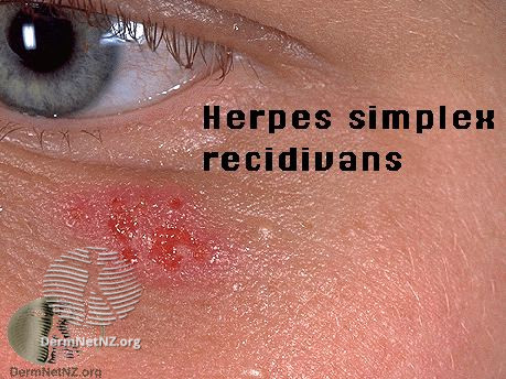 File:Herpes simplex (DermNet NZ 2864).jpg