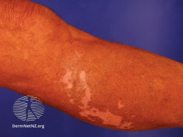 File:Induced by anticonvulsant (DermNet NZ drug-induced-vitiligo-3).jpg