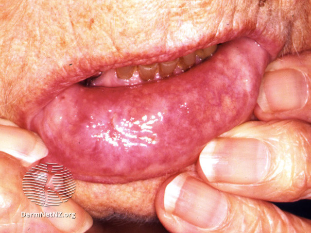 File:Lip ulceration due to granulomatosis with polyangiitis (DermNet NZ systemic-wegener-lip).jpg