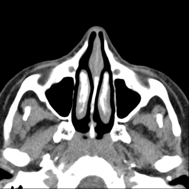 Nasolabial cyst (Radiopaedia 33987-35205 Axial non-contrast 22).jpg