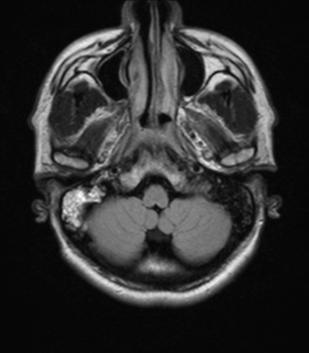 File:Nasopharyngeal carcinoma with pterygopalatine fossa involvement (Radiopaedia 33102-34134 Axial FLAIR 4).png