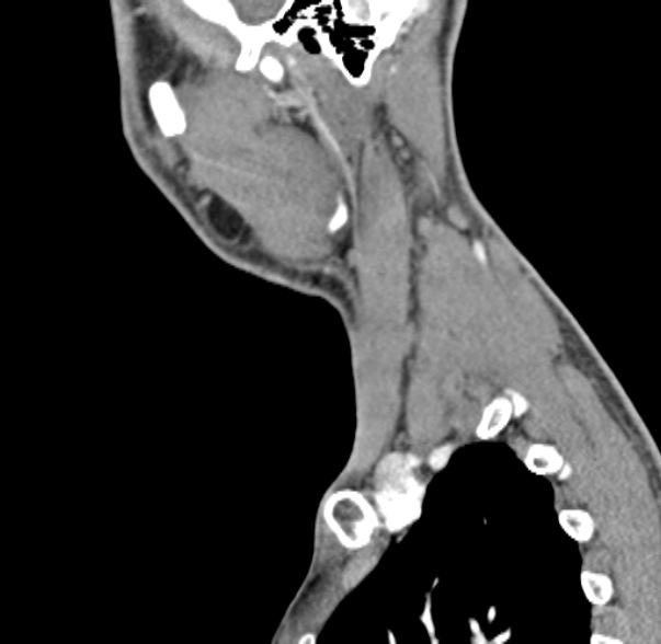 Nasopharyngeal carcinoma with skull base invasion (Radiopaedia 53415-59705 C 10).jpg