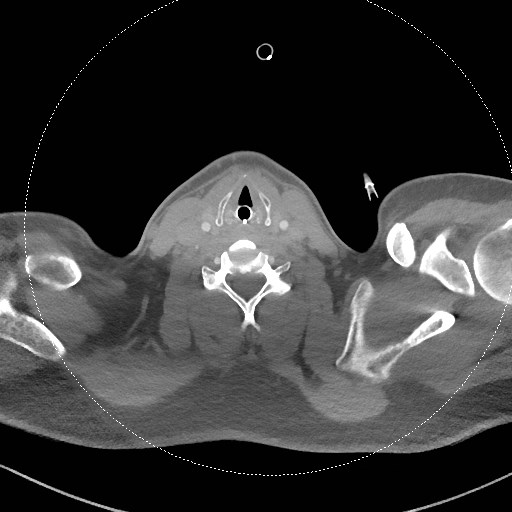 File:Neck CT angiogram (intraosseous vascular access) (Radiopaedia 55481-61945 B 150).jpg