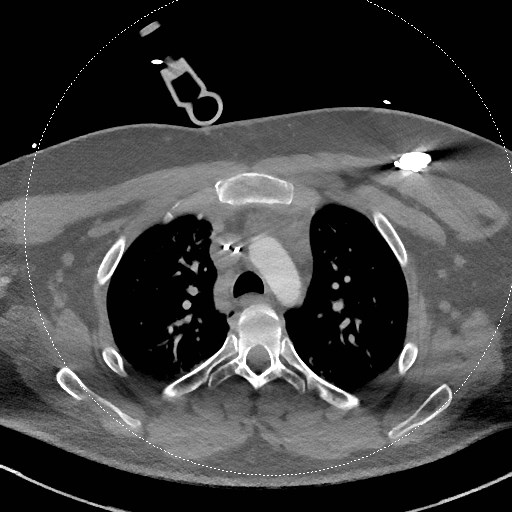 Neck CT angiogram (intraosseous vascular access) (Radiopaedia 55481-61945 B 55).jpg