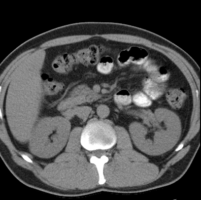File:Necrotizing pancreatitis with acute necrotic collection (Radiopaedia 14470-14417 Axial non-contrast 18).jpg