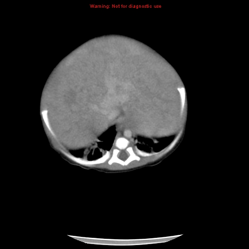File:Neonatal neuroblastoma (Radiopaedia 9564-10223 A 15).jpg