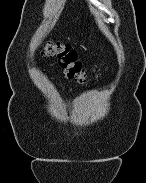 File:Nephrostomy for urosepsis (Radiopaedia 26180-26330 non-contrast 14).jpg