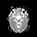 File:Neuro-Behcet's disease (Radiopaedia 21557-21505 Axial ADC 9).jpg