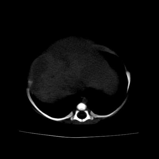 File:Neuroblastoma (Radiopaedia 20876-20799 Axial bone window 4).jpg