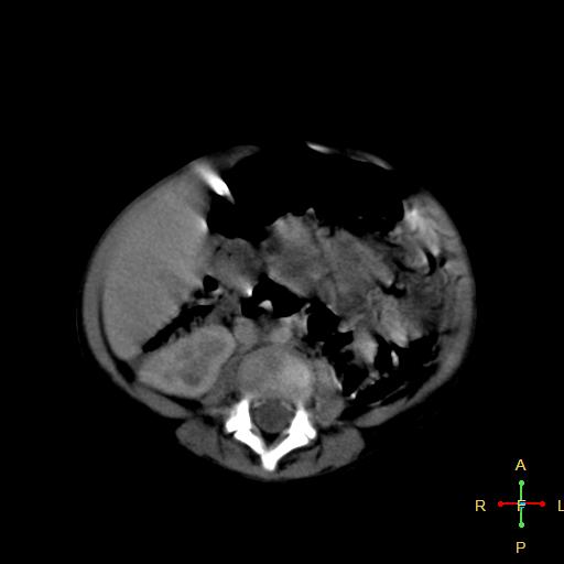 File:Neuroblastoma (Radiopaedia 24751-25016 D 25).jpg