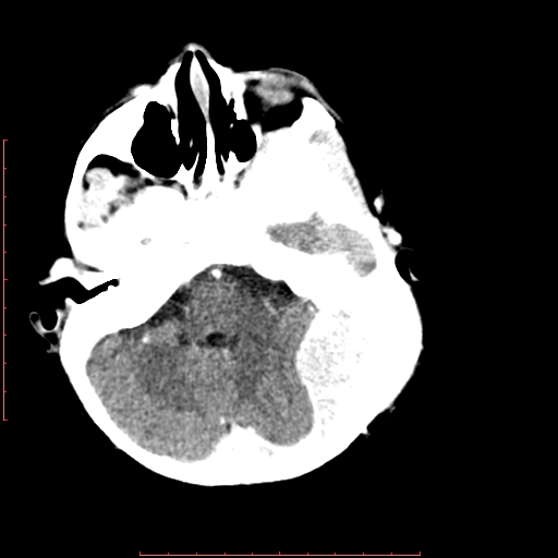 File:Neuroblastoma skull metastasis (Radiopaedia 56053-62683 Axial +Contrast 5).jpg
