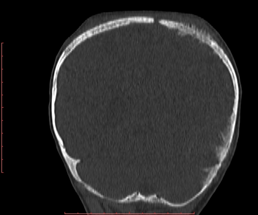 File:Neuroblastoma skull metastasis (Radiopaedia 56053-62683 Coronal bone window 31).jpg